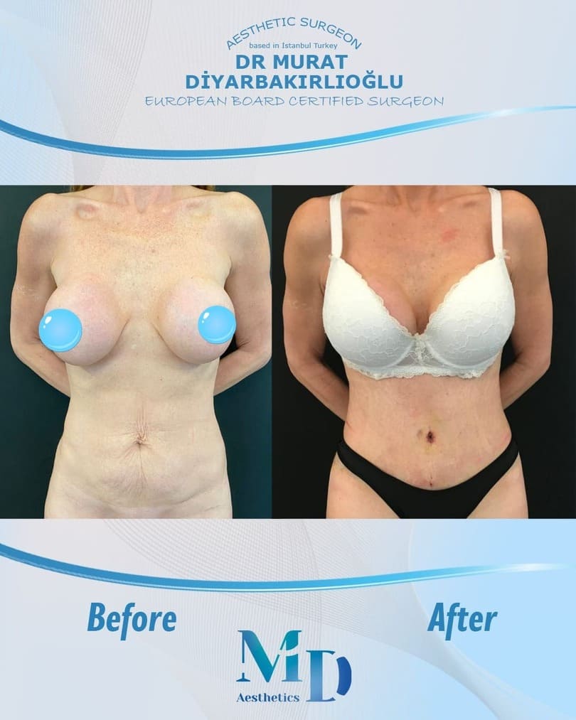 breast aesthetics before and after - 1