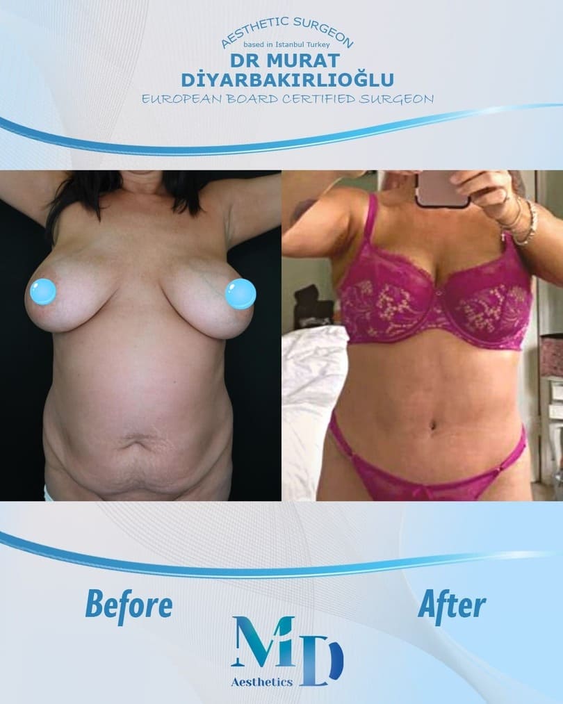 breast aesthetics before and after - 13