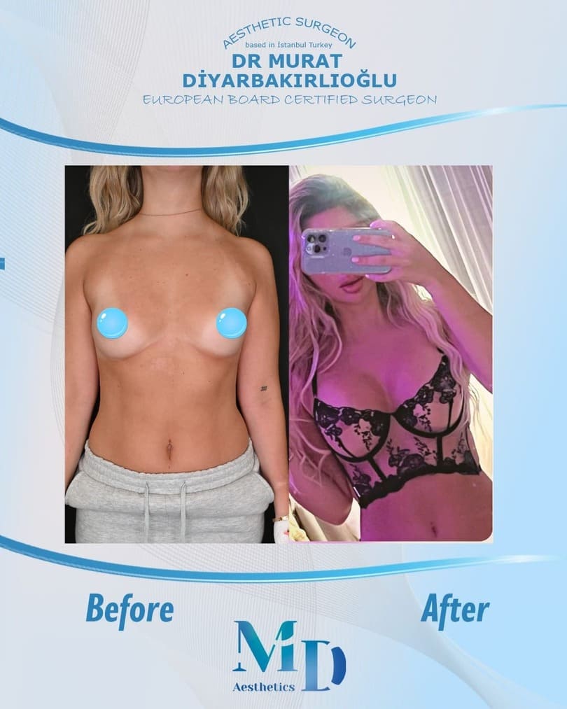 breast aesthetics before and after - 17