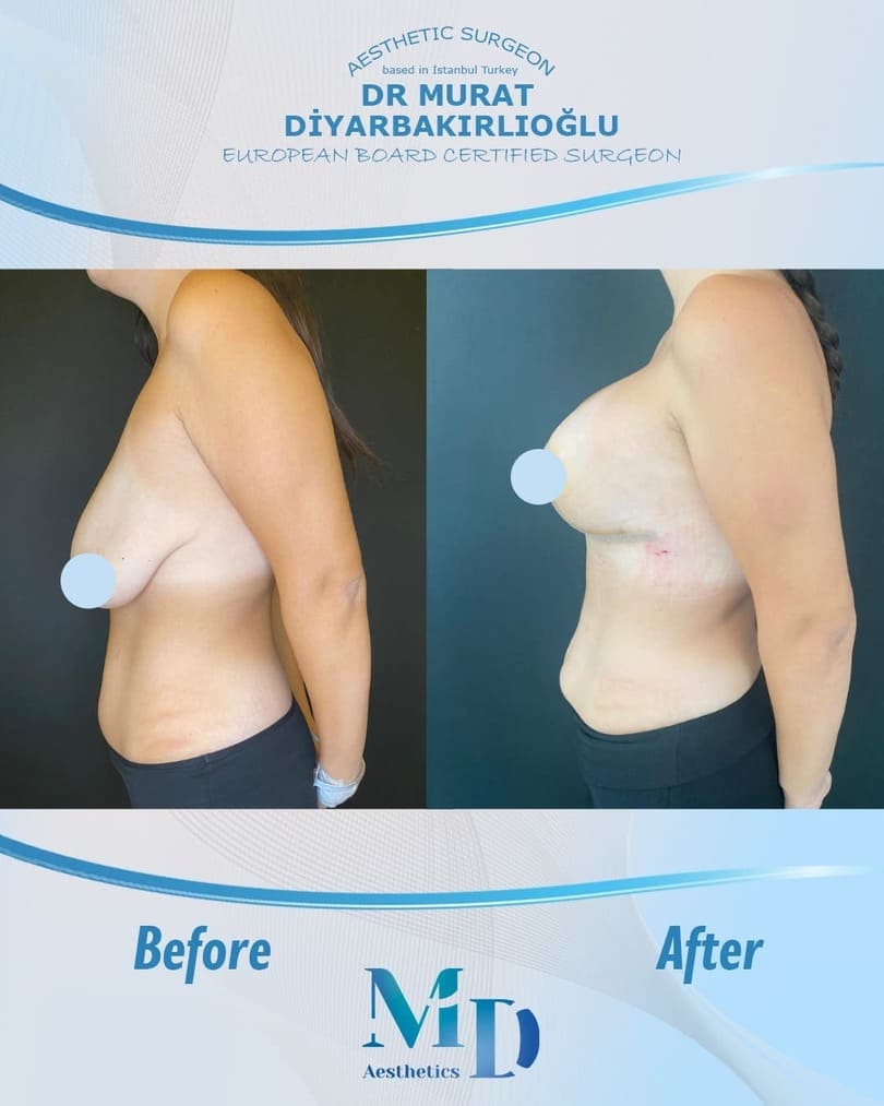 breast aesthetics before and after - 2