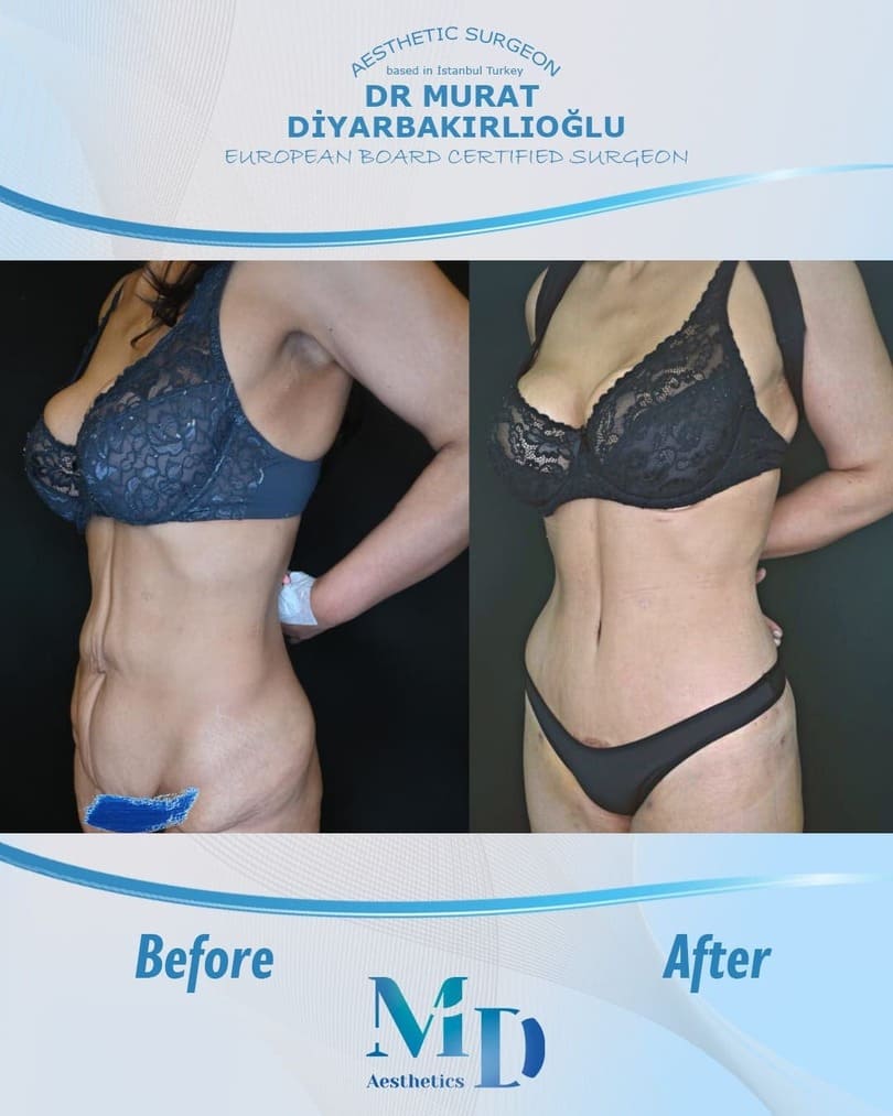 tummy tuck before and after - 21