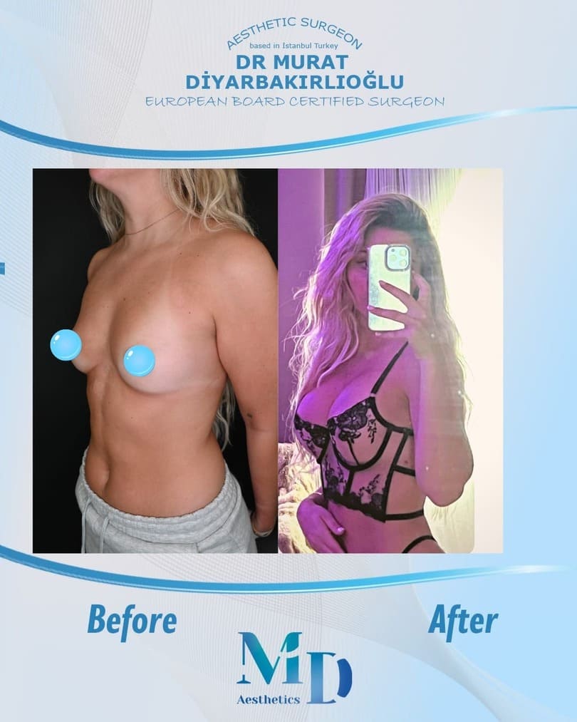 breast aesthetics before and after - 24