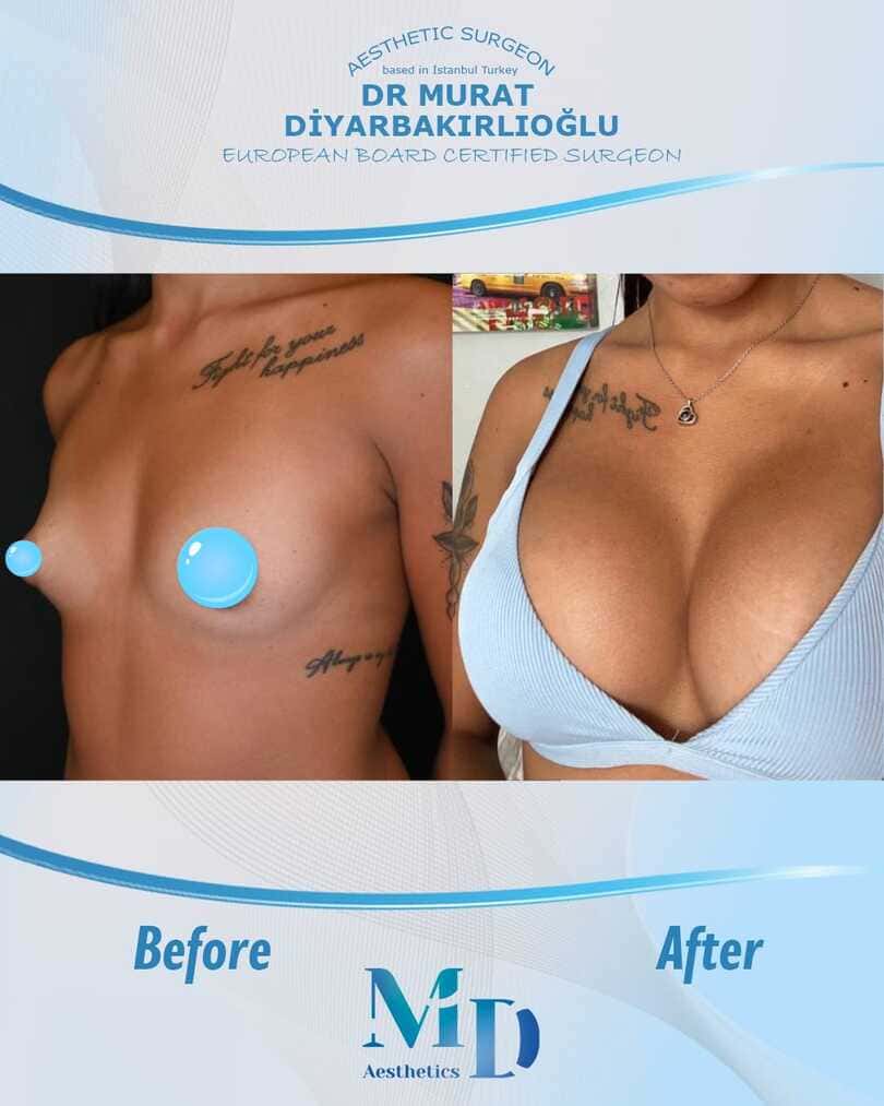 تجميل الثدي قبل وبعد - 26