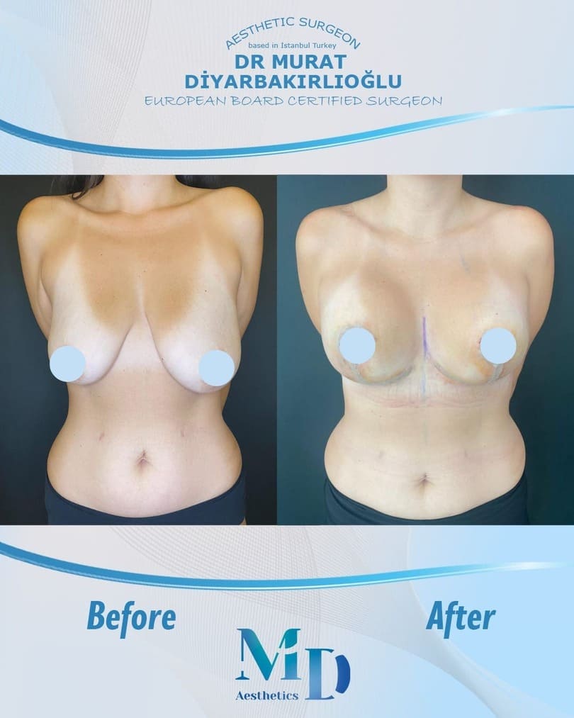breast aesthetics before and after - 3