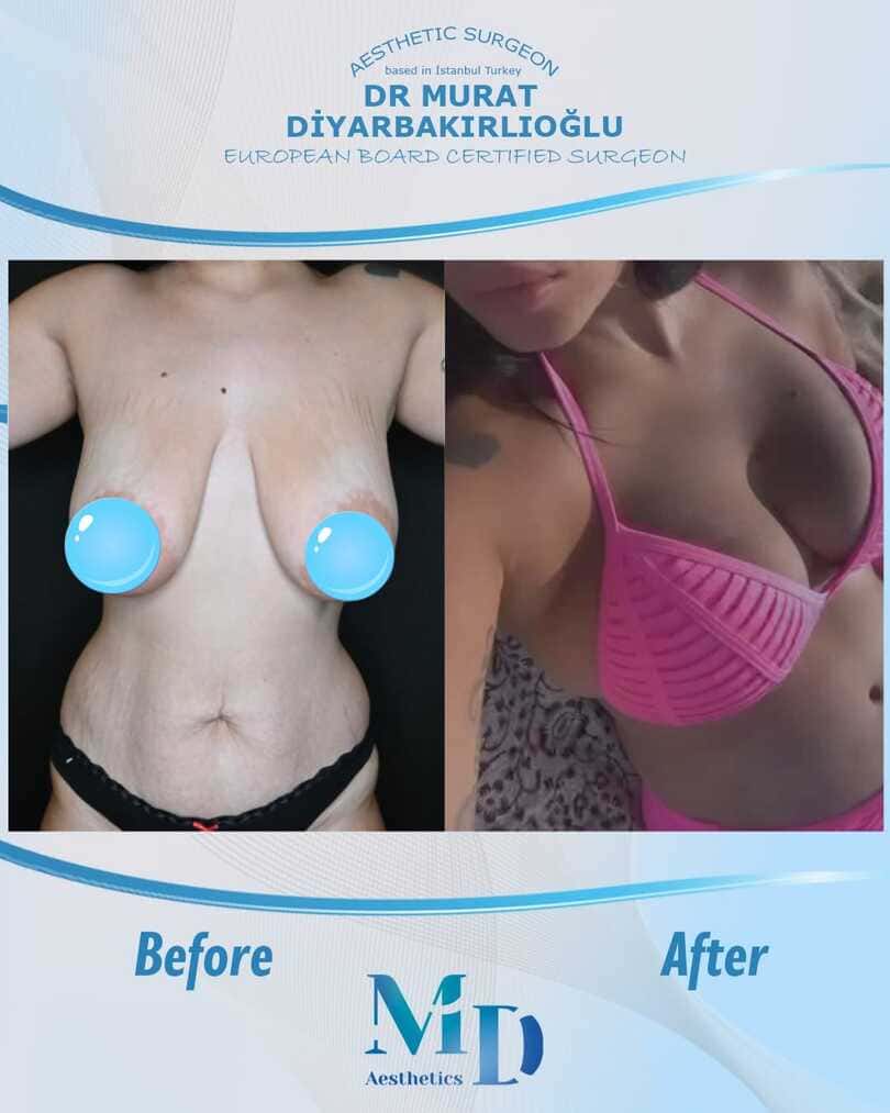تجميل الثدي قبل وبعد - 28