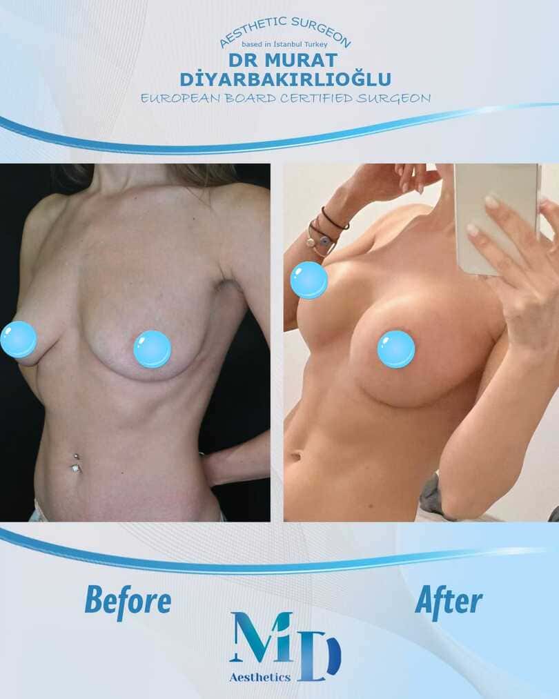 breast aesthetics before and after - 29