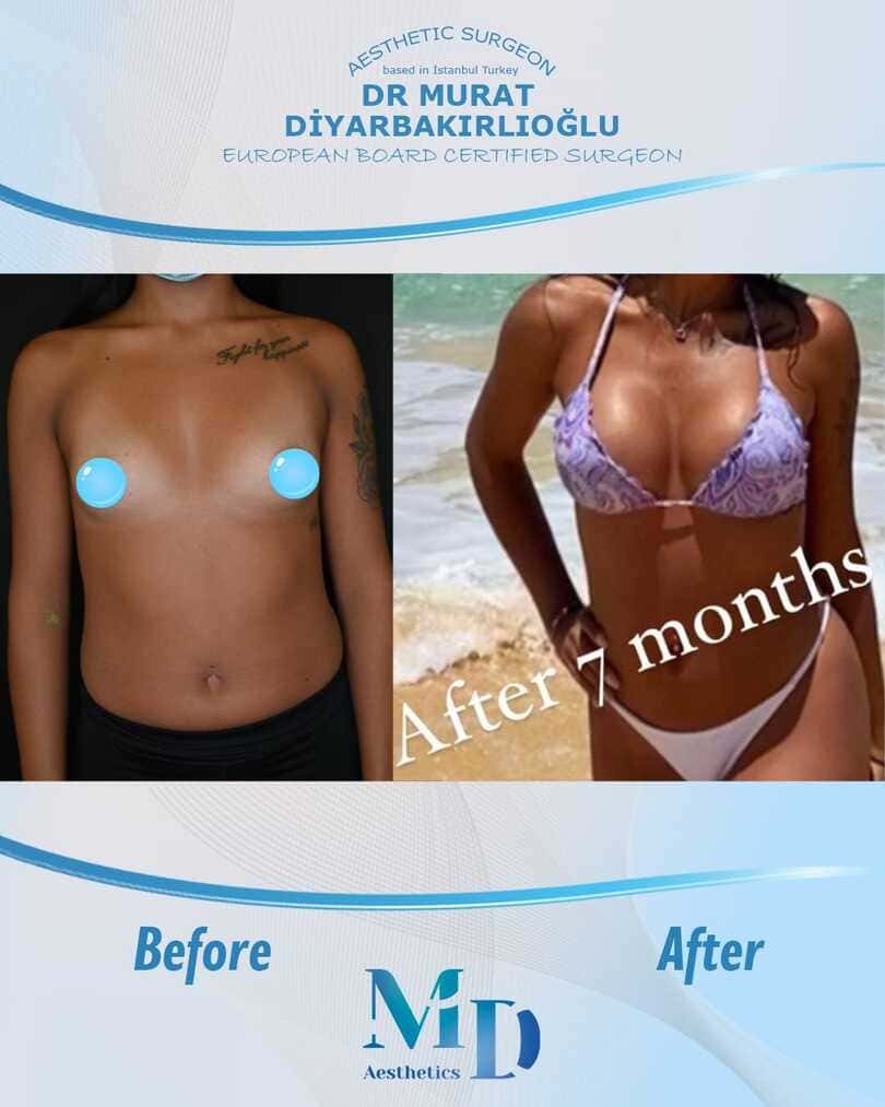 breast aesthetics before and after - 31