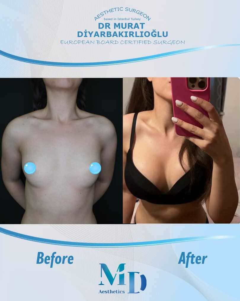 breast aesthetics before and after - 34