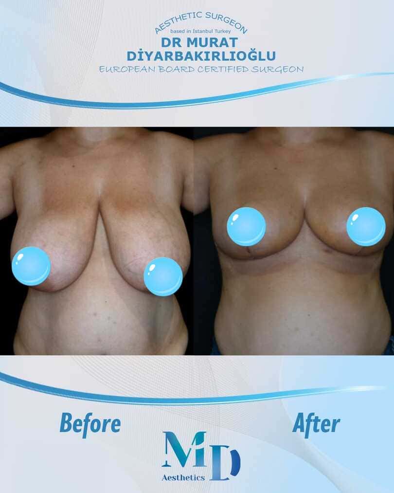 breast aesthetics before and after - 35