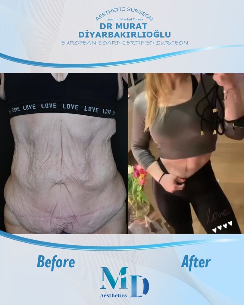 tummy tuck before and after - 39