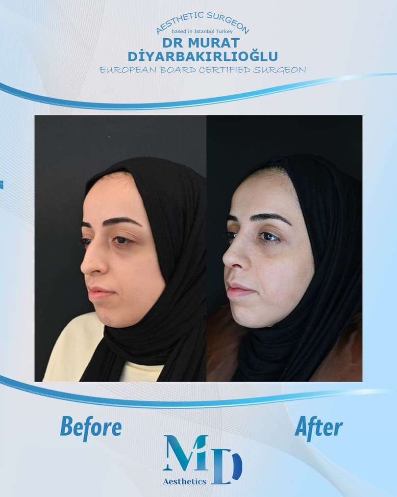 rhinoplasty aesthetics before and after - 40