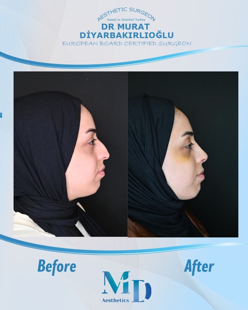 rhinoplasty aesthetics before and after - 41