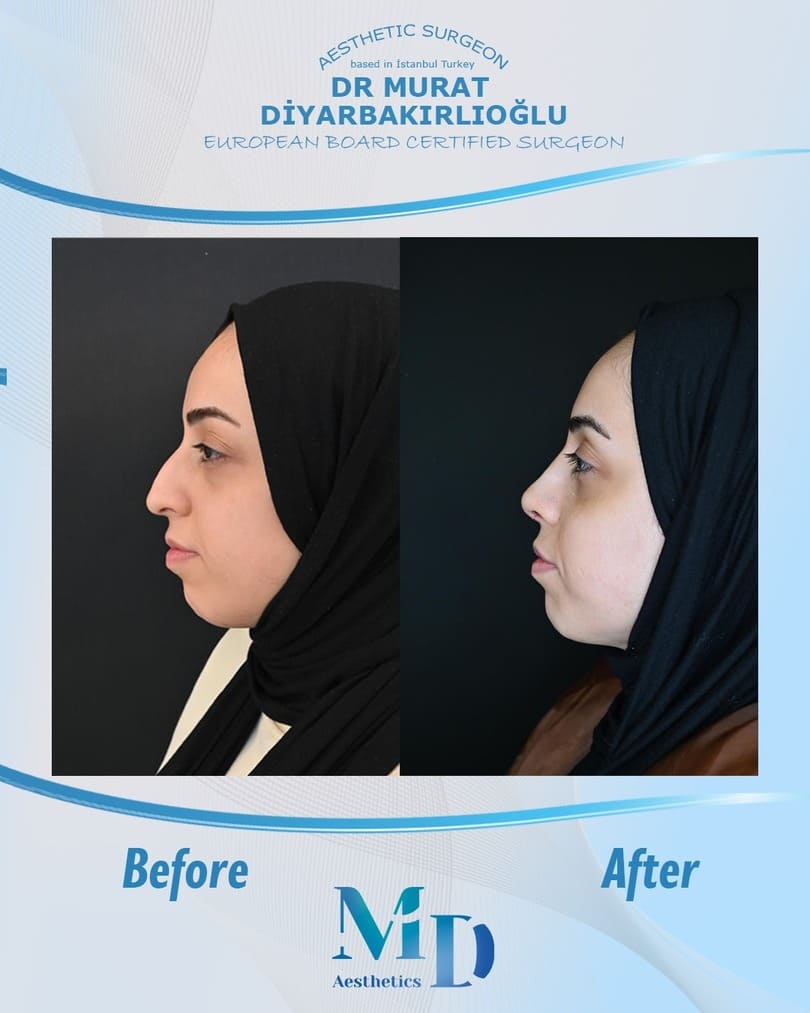 rhinoplasty aesthetics before and after - 42