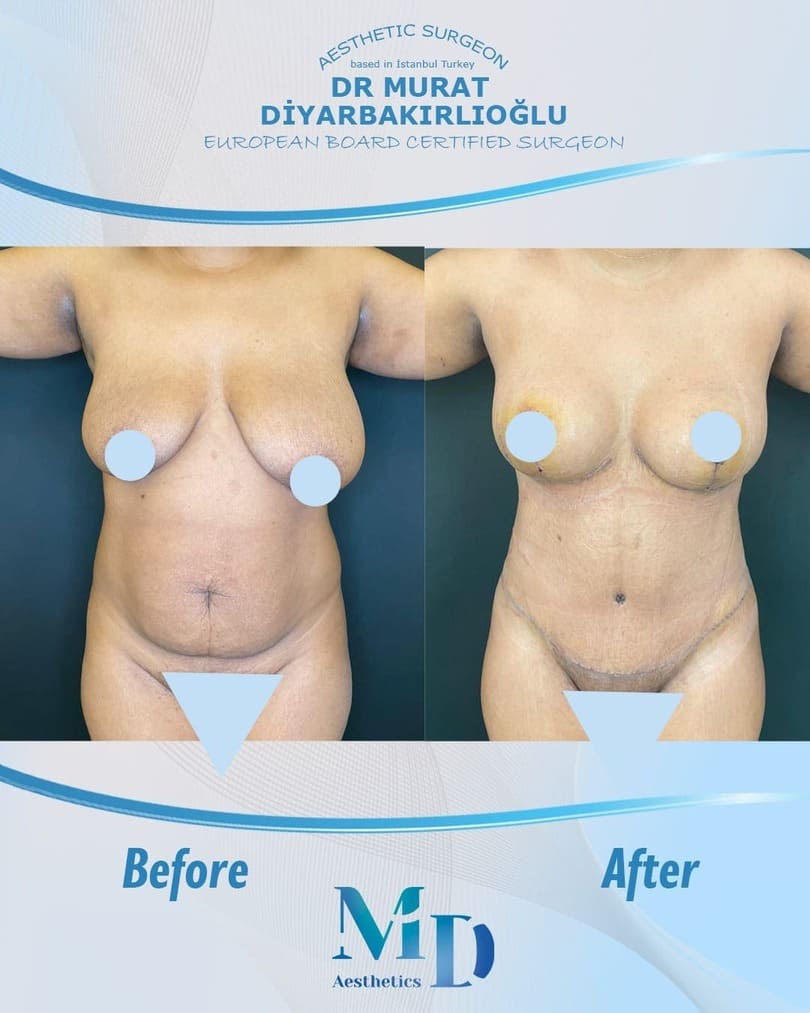 breast aesthetics before and after - 5