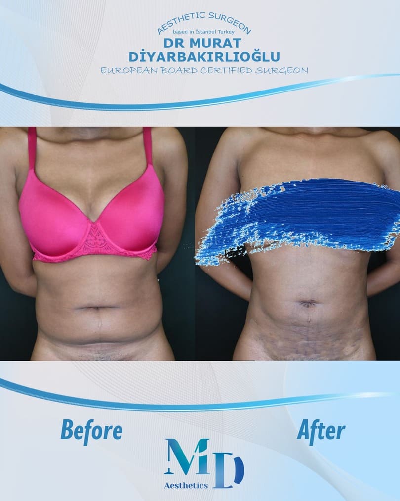tummy tuck before and after - 46