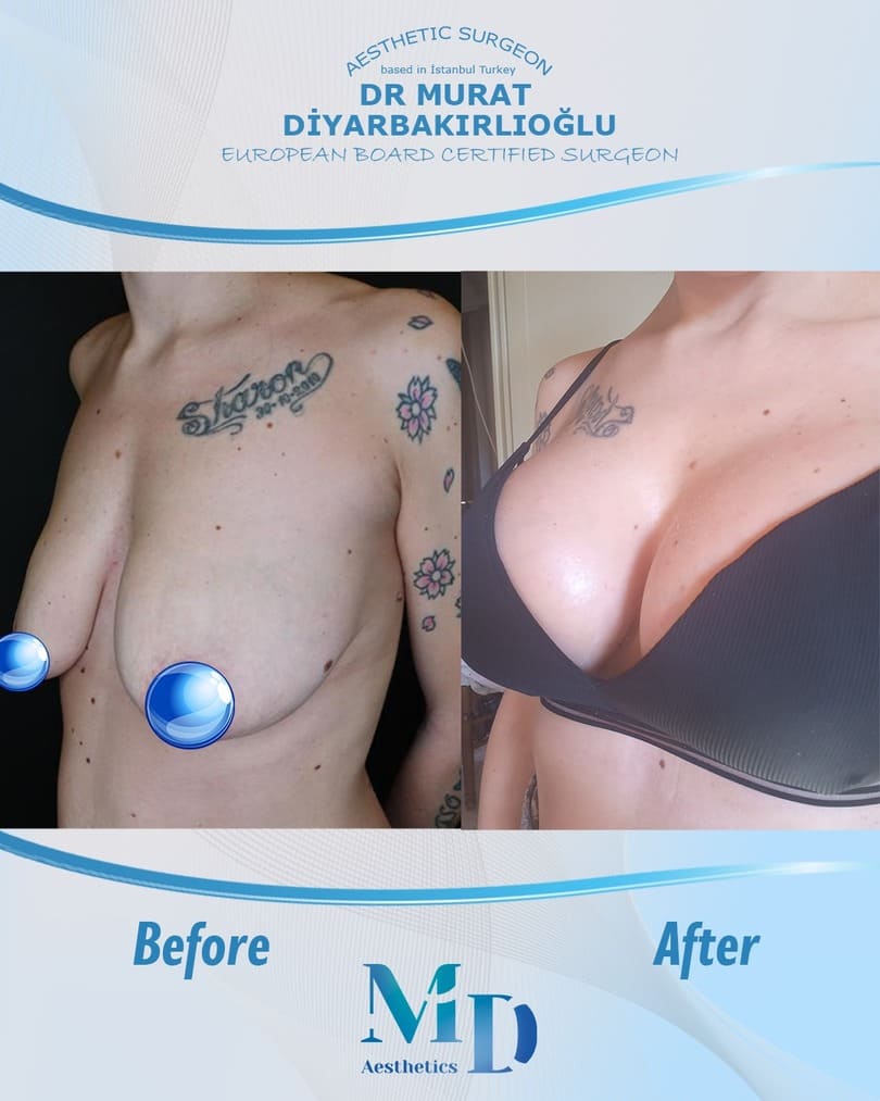 breast aesthetics before and after - 47