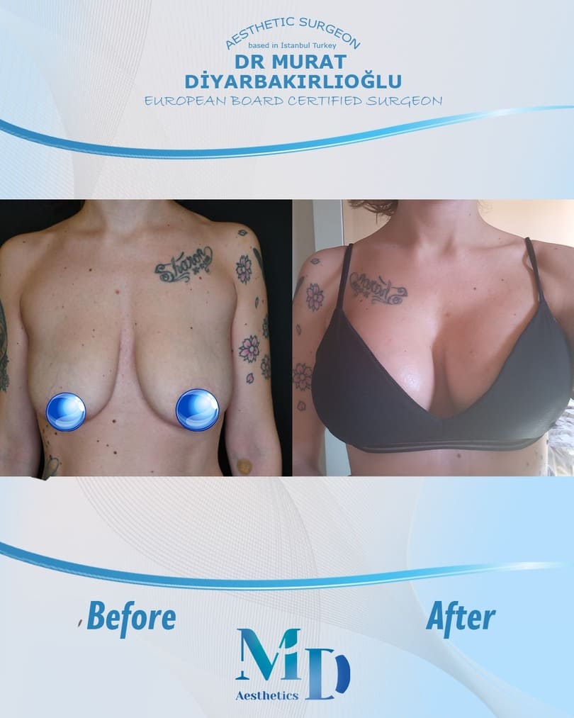 breast aesthetics before and after - 48