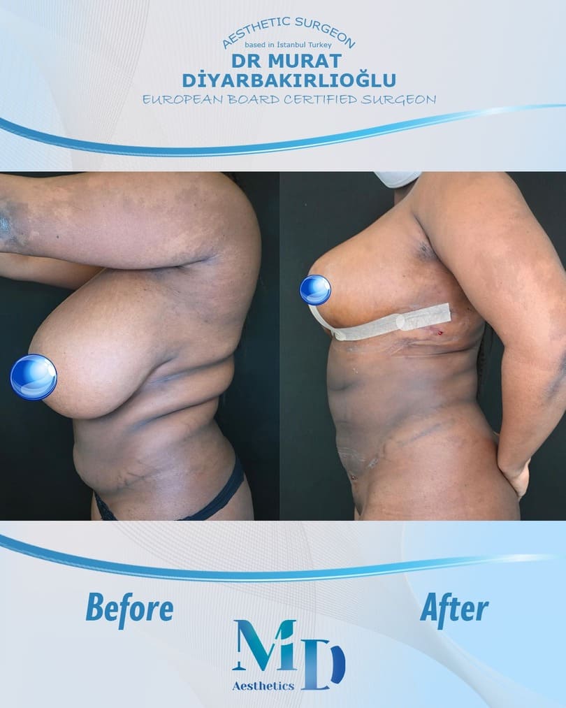 tummy tuck before and after - 51