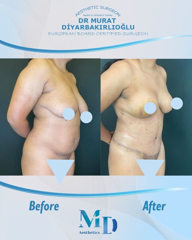 breast aesthetics before and after - 6