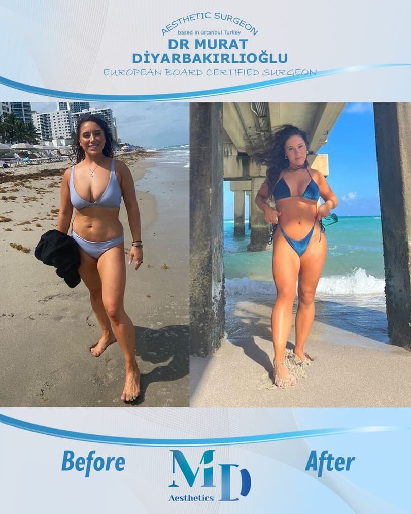breast aesthetics before and after - 56