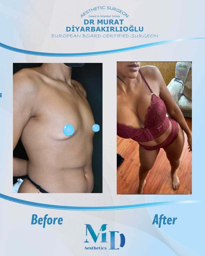 breast aesthetics before and after - 59