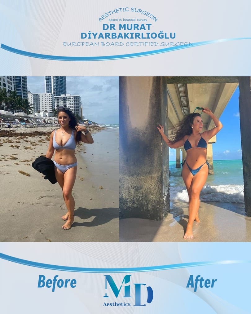 breast aesthetics before and after - 61