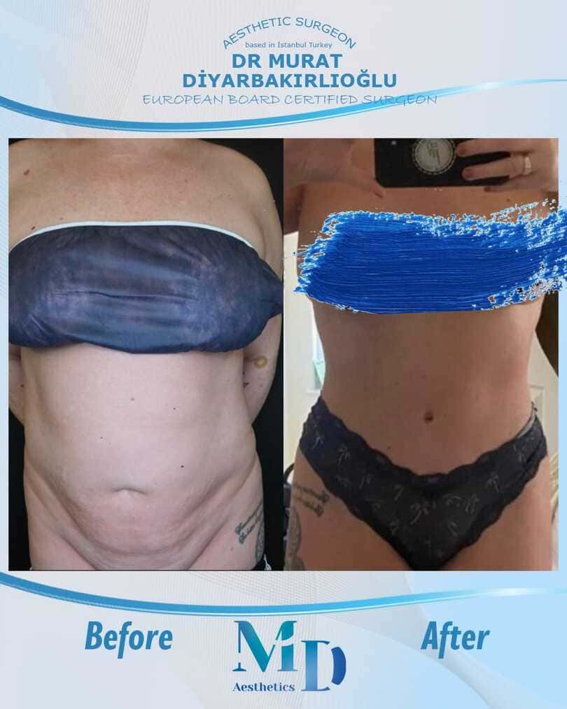 tummy tuck before and after - 62