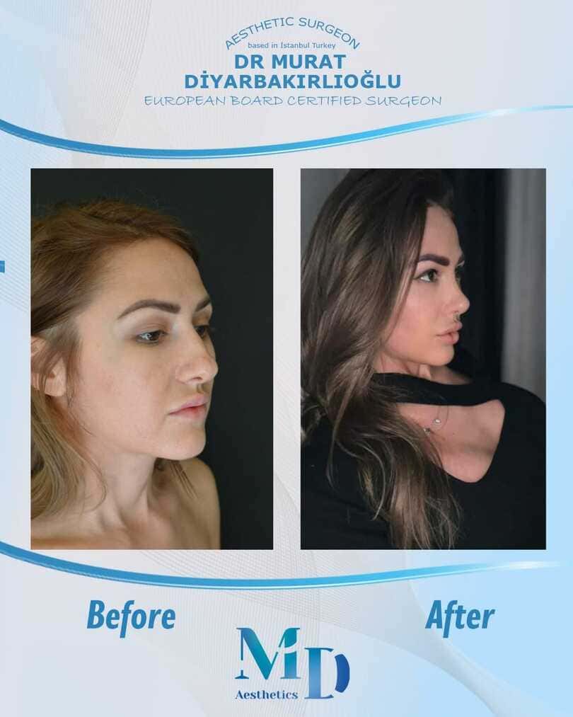 rhinoplasty aesthetics before and after - 63