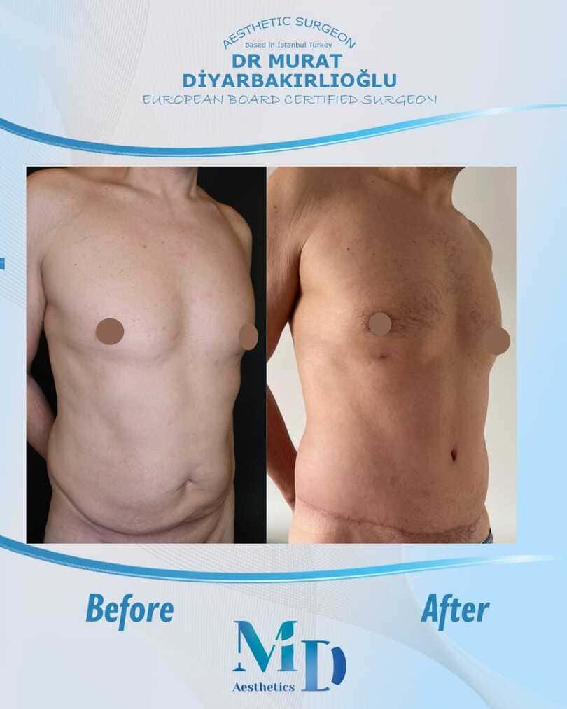 tummy tuck before and after - 64