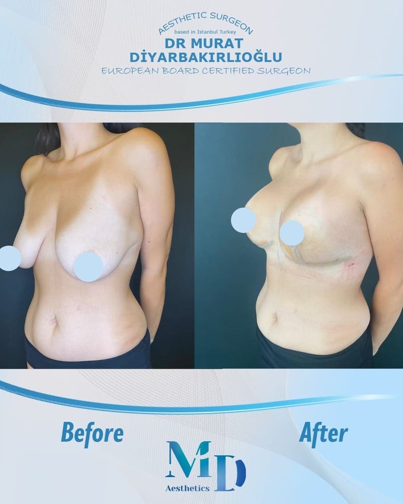 breast aesthetics before and after - 7