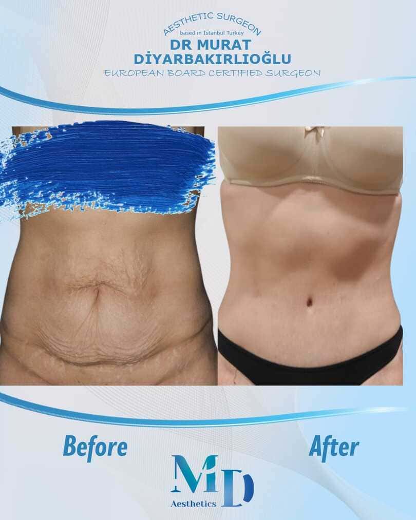 tummy tuck before and after - 70