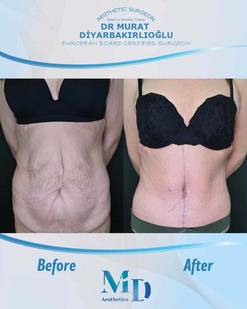 tummy tuck before and after - 71
