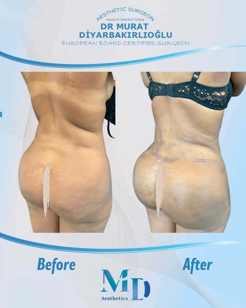 butt aesthetics before and after - 72