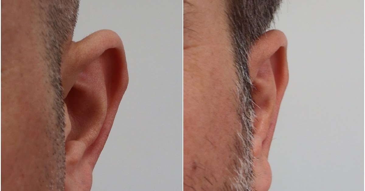 PROMINENT EAR AESTHETICS
