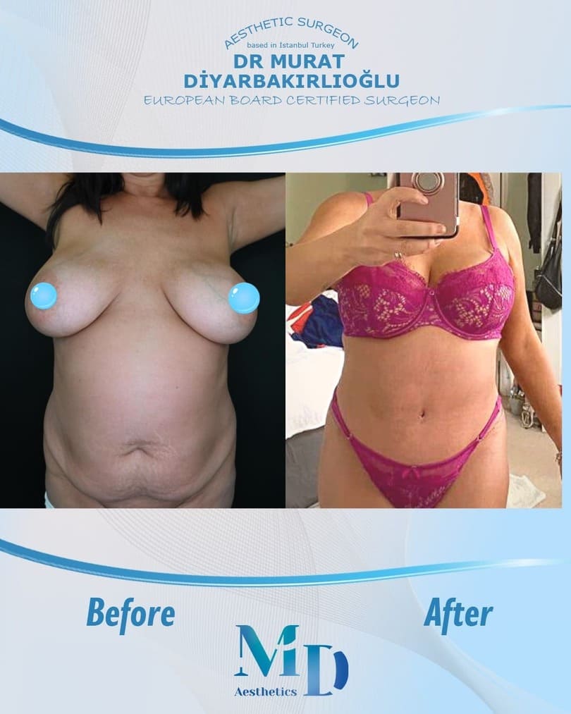 Murat Diyarbakırlıoğlu | Mommy Makeover