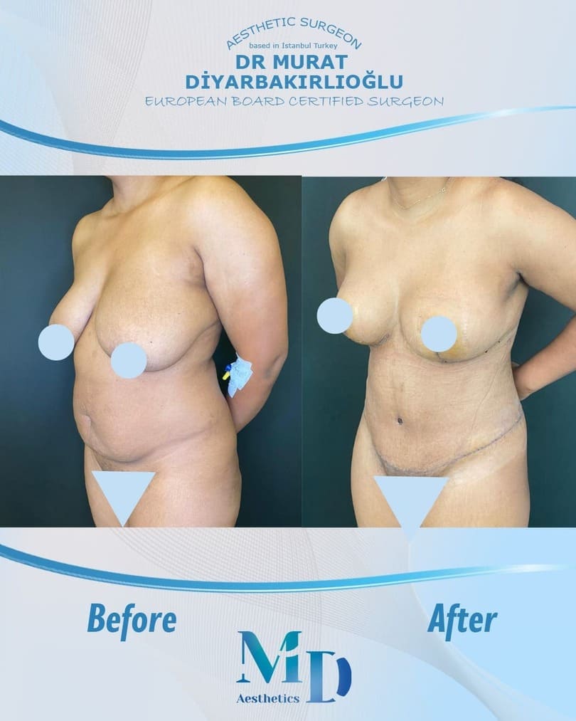 Murat Diyarbakırlıoğlu | Mommy Makeover