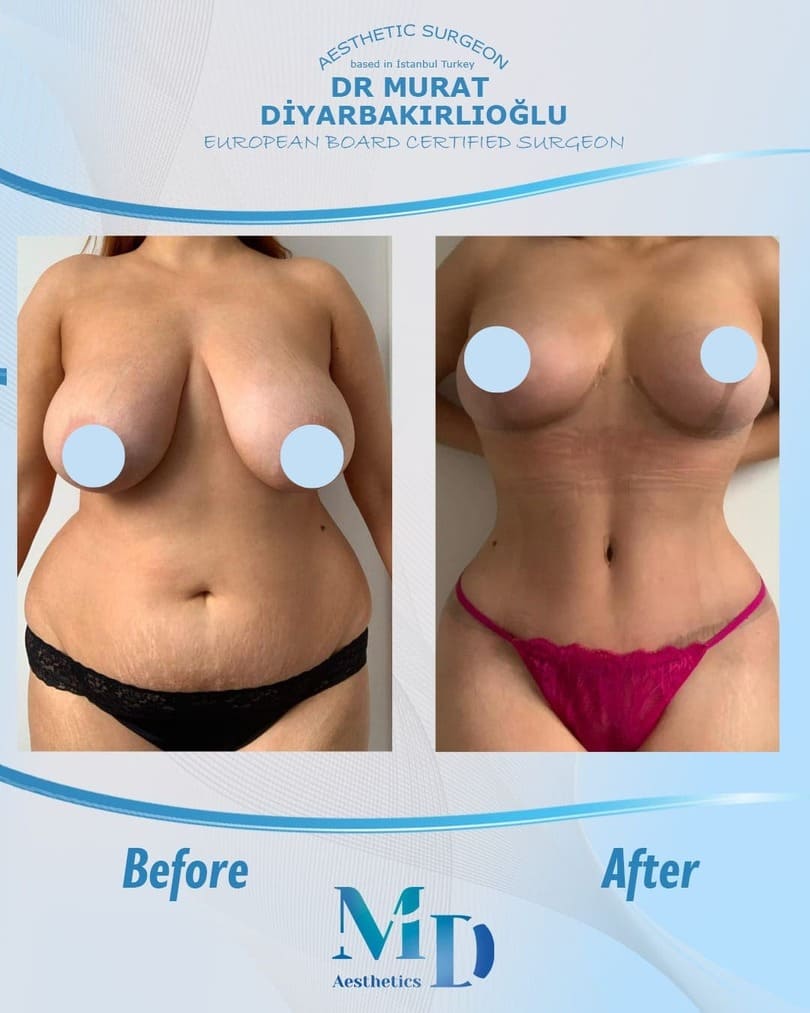 Murat Diyarbakırlıoğlu | Mommy Makeover