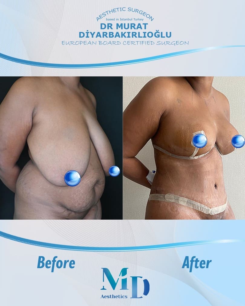 Murat Diyarbakırlıoğlu | Mommy Makeover