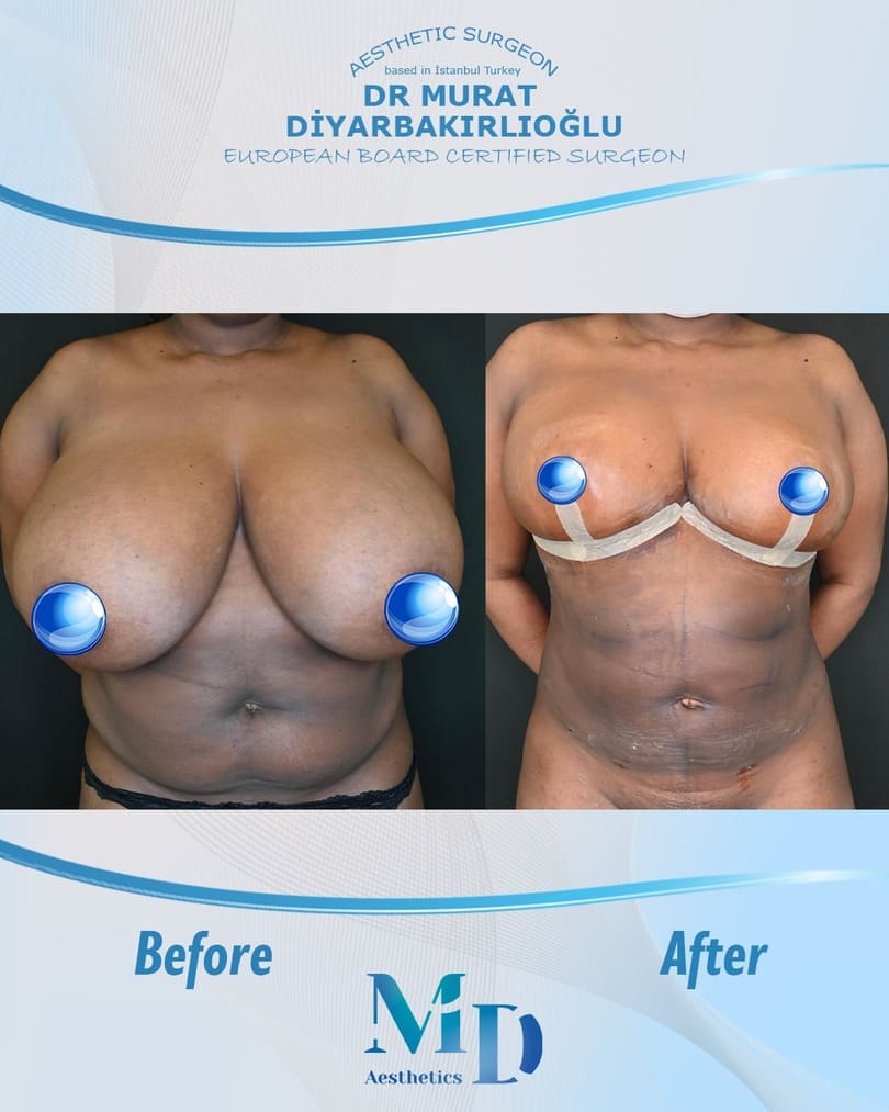 Murat Diyarbakırlıoğlu | Mommy Makeover