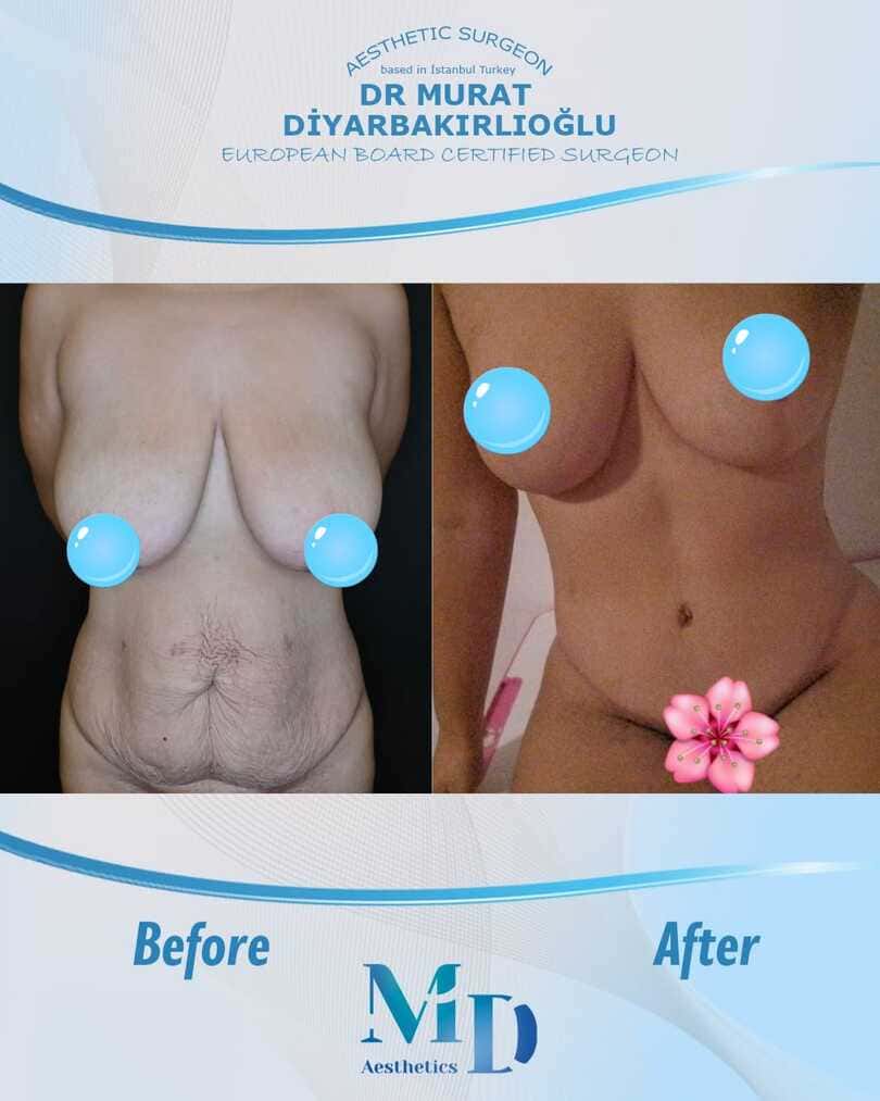 Murat Diyarbakırlıoğlu | Mommy Makeover