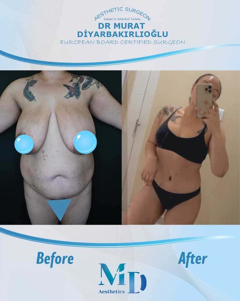 Murat Diyarbakırlıoğlu | Mommy Makeover