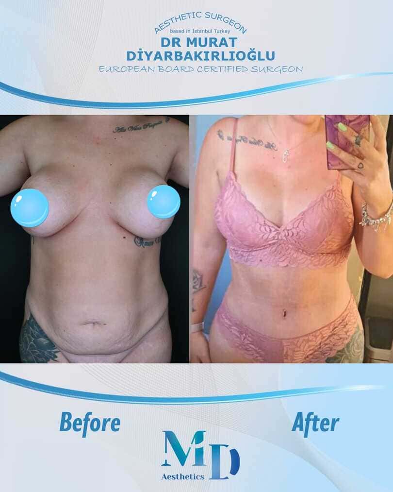 Murat Diyarbakırlıoğlu | Mommy Makeover