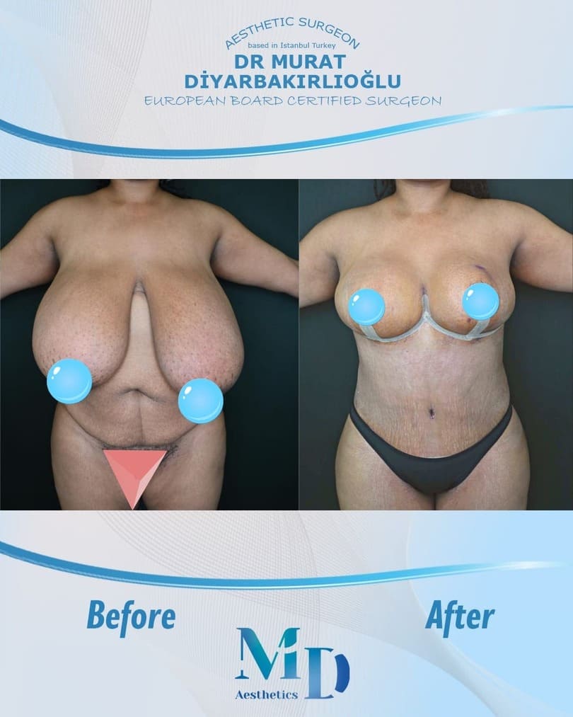 Murat Diyarbakırlıoğlu | Mommy Makeover