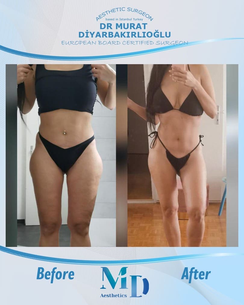 Murat Diyarbakırlıoğlu | BBL Butt Lift