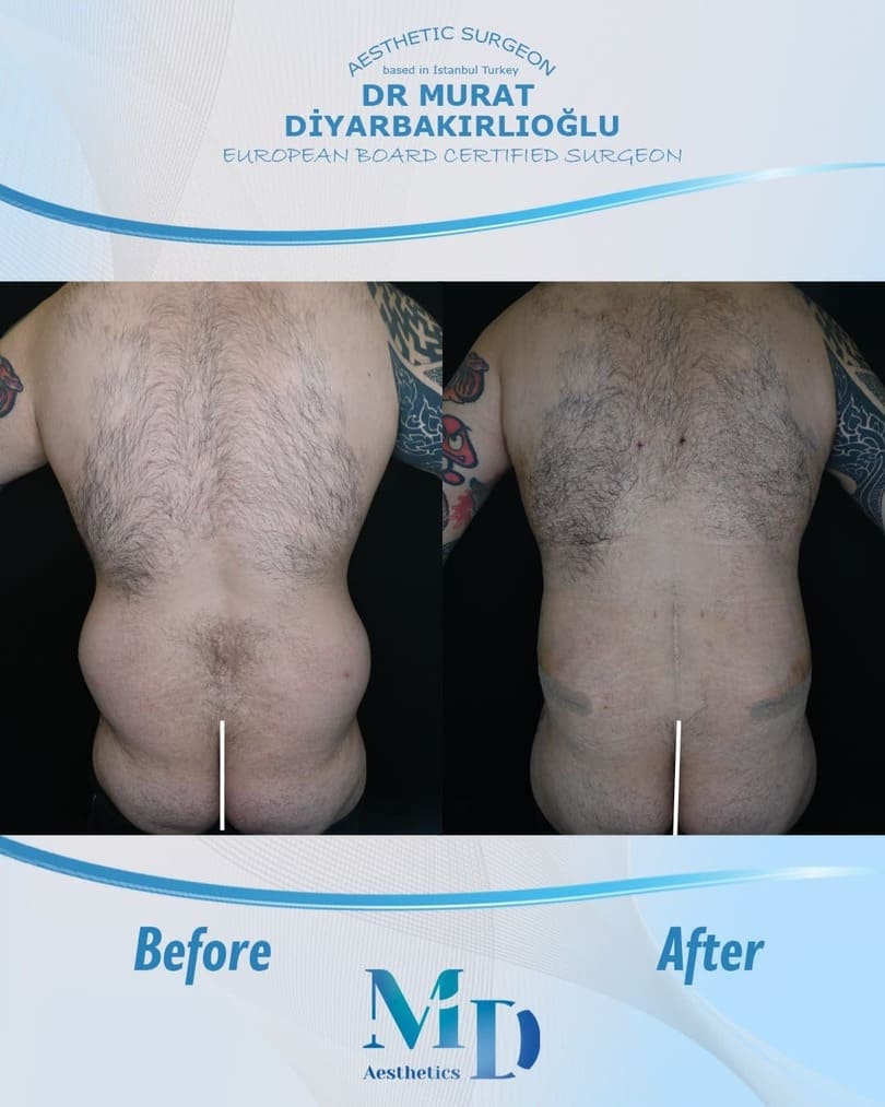 Murat Diyarbakırlıoğlu | BBL Butt Lift