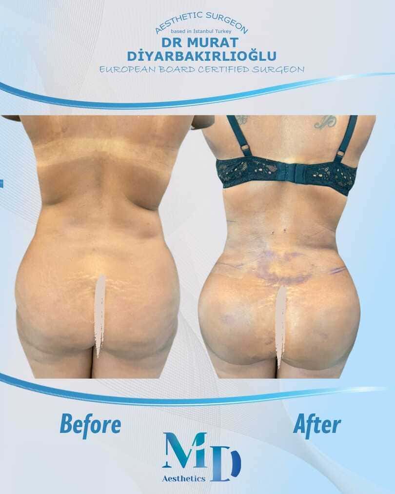 Murat Diyarbakırlıoğlu | BBL Butt Lift
