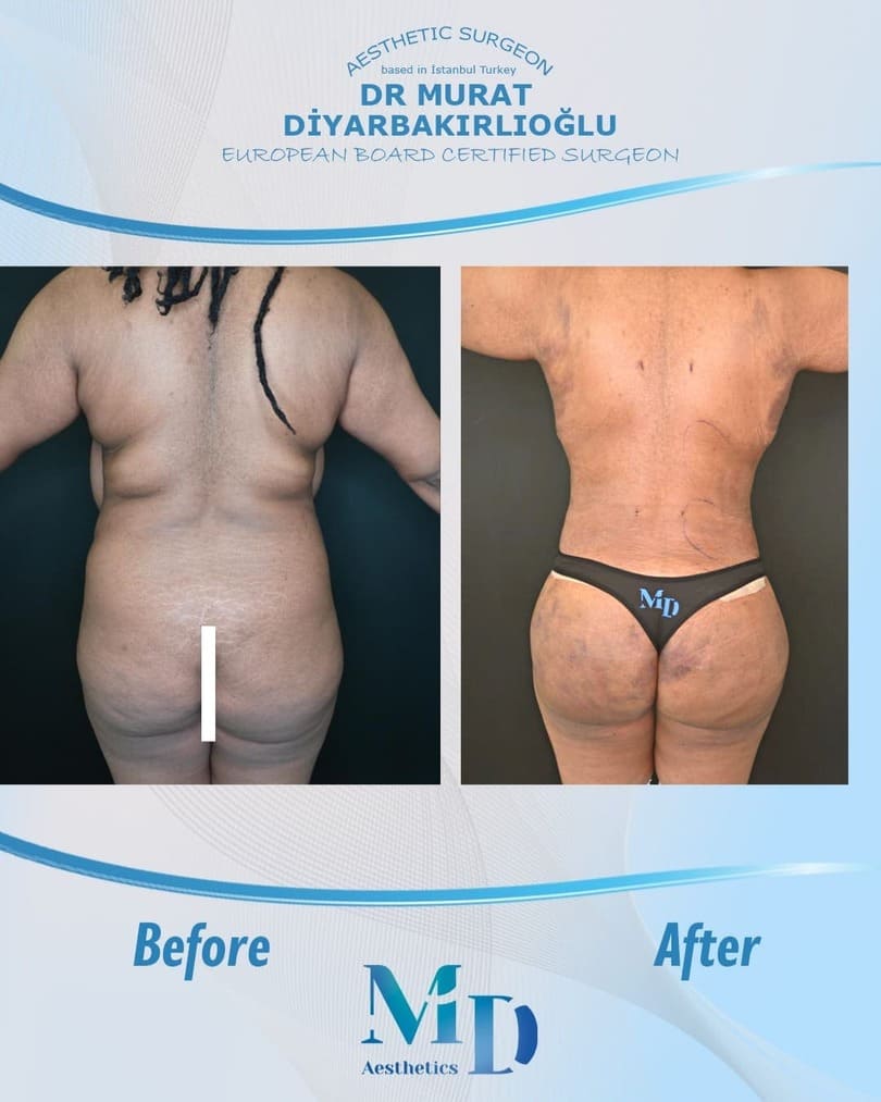 Murat Diyarbakırlıoğlu | BBL Butt Lift