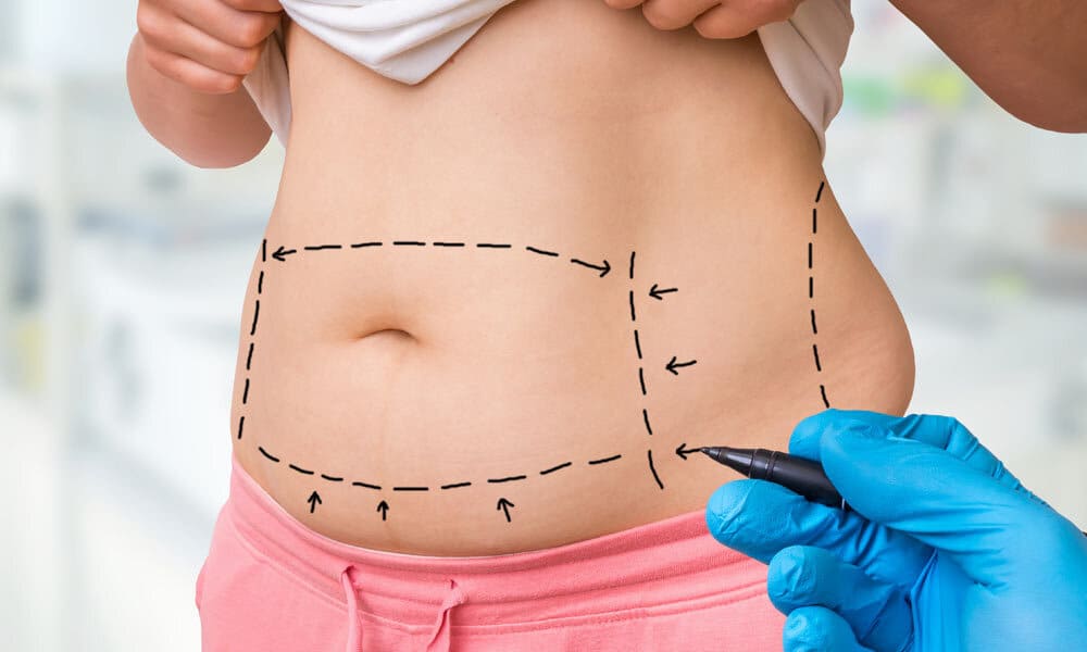 Murat Diyarbakırlıoğlu | 5 questions sur l’esthétique de l’abdominoplastie