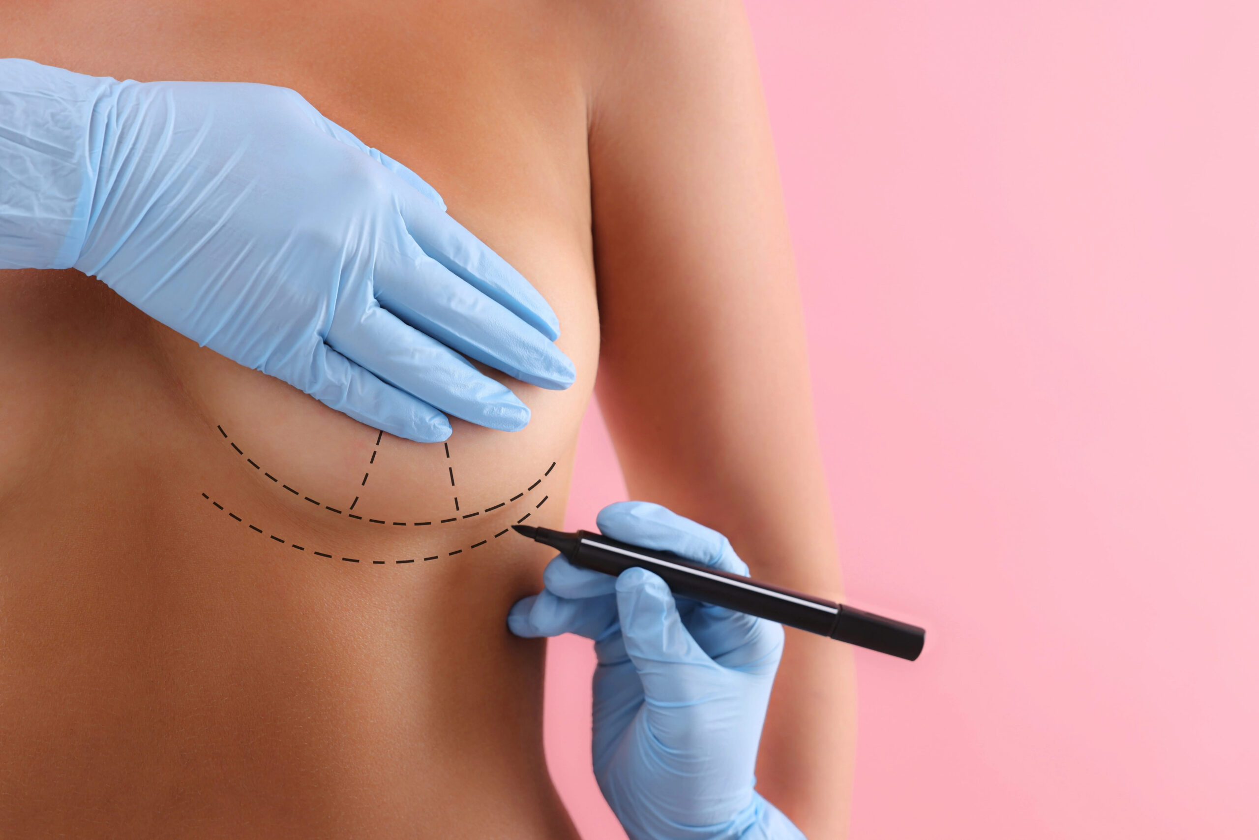 Murat Diyarbakırlıoğlu | Breast Lift