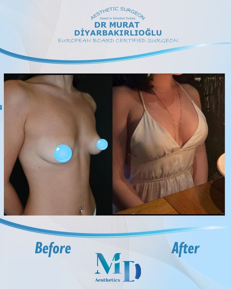 Murat Diyarbakırlıoğlu | Breast Lift